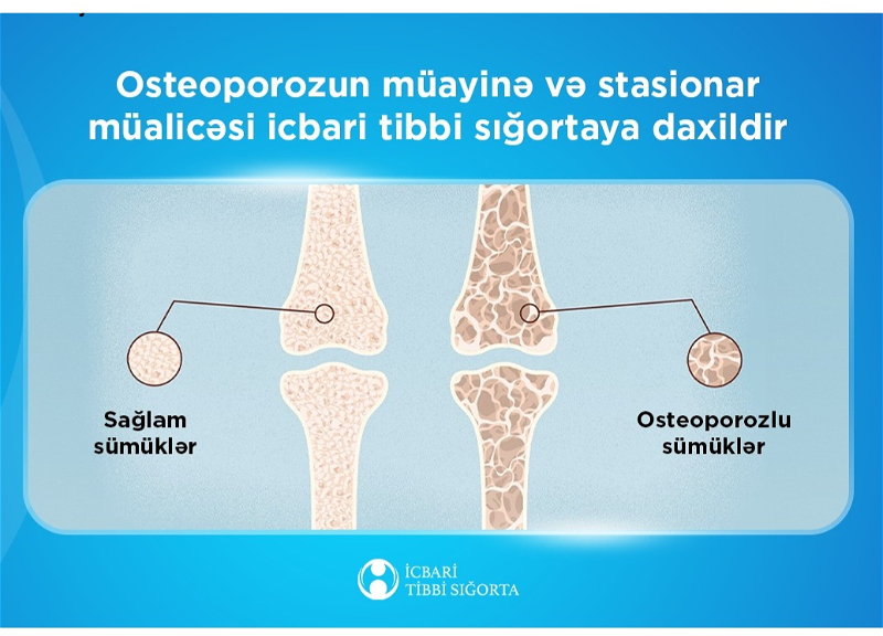 Обследование и стационарное лечение остеопороза включены в ОМС